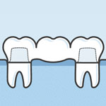 dental-bridge-cartoon-sq-150