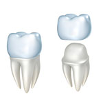 dental-crown-illustration-sq-150