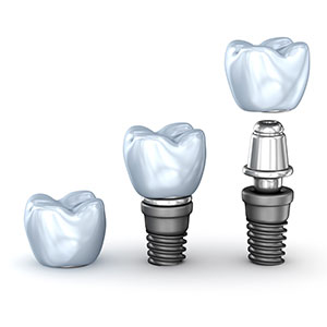 dental-implant-illustration-sq-300