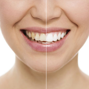 teeth-whitening-sq-300